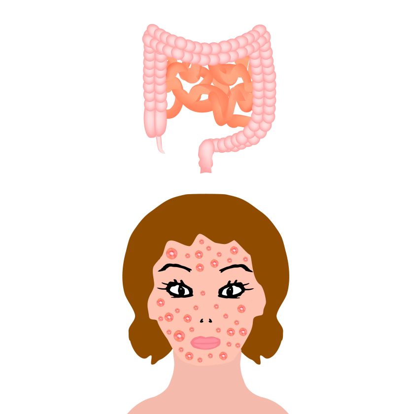 Anatomická struktura střeva. Střevní onemocnění postihují kůži a vektorové ilustrace.